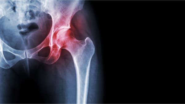 arthrose de la hanche symptomes arthrose de la hanche que faire arthrose hanche symptome docteur marc elkaim chirurgien orthopedique chirurgien hanche paris
