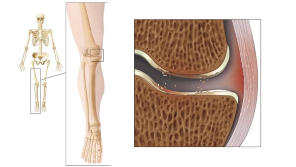 arthrose du genou symptome arthrose genoux exercices arthrose genou que faire docteur marc elkaim chirurgien orthopedique chirurgien genou paris
