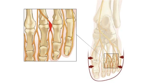 nevrome de morton diagnostic nevrome de morton irm nevrome de morton symptomes docteur marc elkaim chirurgien orthopedique chirurgien du pied paris