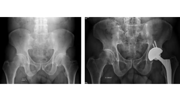 prothese totale hanche prothese de hanche reeducation docteur marc elkaim chirurgien hanche paris chirurgie hanche clinique drouot 1