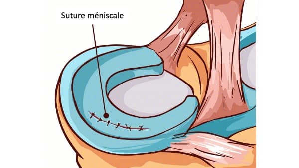 suture meniscale suites operatoires operation docteur marc elkaim chirurgien genou paris