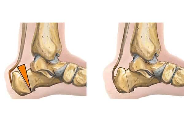 osteotomie de zadek tendon d achille dr marc elkaim chirurgien orthopedique chirurgien du pied paris 9