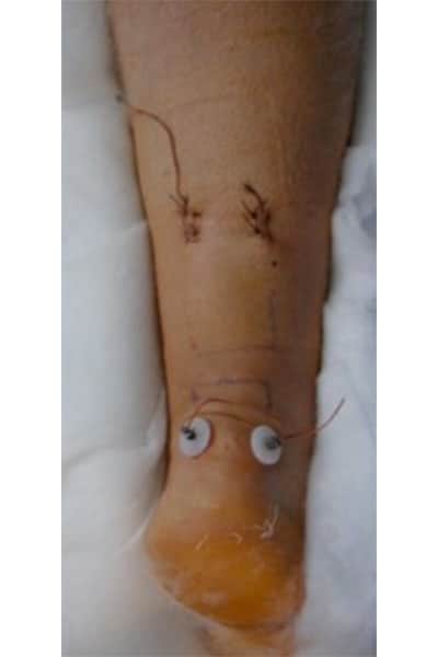 traitement chirurgical percutane rupture complete tendon d achille docteur marc elkaim chirurgien orthopedique chirurgien du pied paris 9